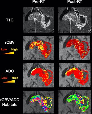 Visualising spatial heterogeneity in glioblastoma using imaging habitats